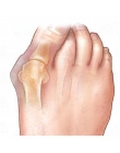 Palucha Koślawego Ortezy Palucha Korektor Foot Pain Relief Pielęgnacja Stóp Kości Zespół Cieśni Kanału Nadgarstka Korektor Dzień