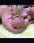 Ingrown pedicure stóp pielęgnacja paznokci paznokcie narzędzia plików do stóp ortezy acronyx ingrowing paznokci onyxis zespół ci